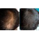 Plaukų mezoterapija + dovana ampulė po plaukų plovimo
